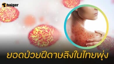 ยอดป่วยฝีดาษลิงในไทยพุ่ง