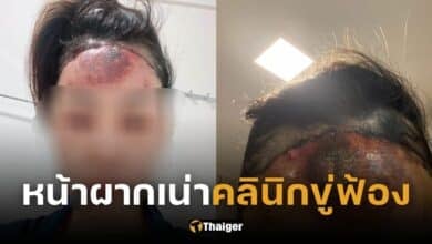 สาวศัลยกรรมหน้าผากร้องเรียน แผลเน่าติดเชื้อ เจอคลินิกขู่ฟ้อง ปัดรับผิดชอบ