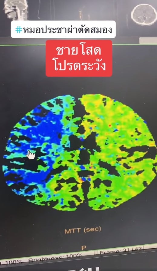 หลังฉีดสีในสมองพบลิ่มเลือดอุดตัน