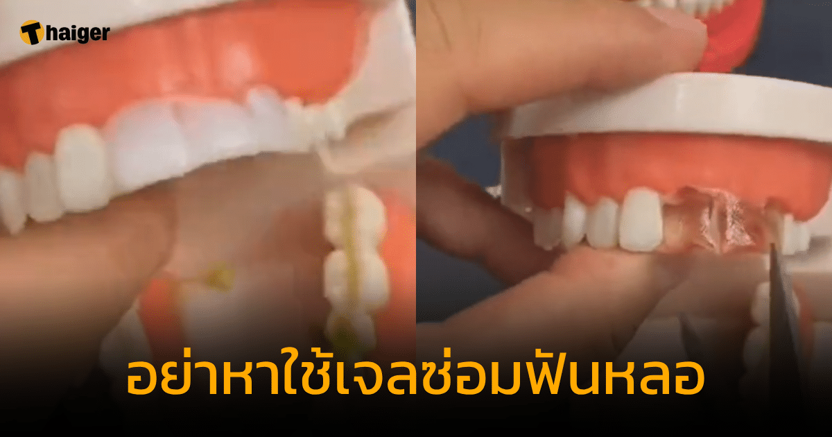 เจลซ่อมฟัน เสี่ยงเกิดปัญหาช่องปากเพียบ