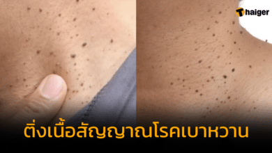 ติ่งเนื้อสัญญาณโรคเบาหวาน