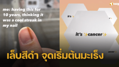 เล็บเป็นเส้นสีดำนาน 10 ปี คิดว่าไม่ร้ายแรง สุดท้ายเป็นมะเร็ง
