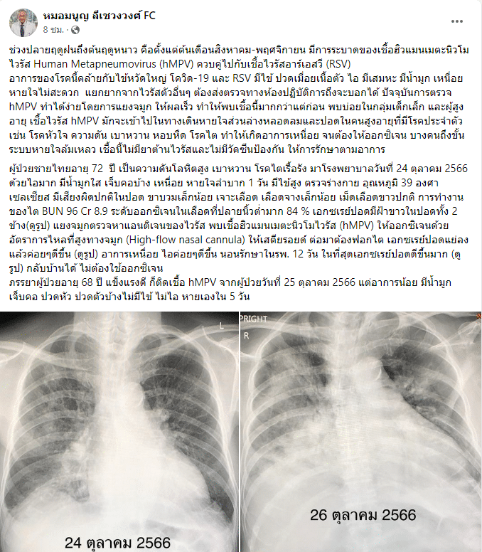 ไวรัส hMPV