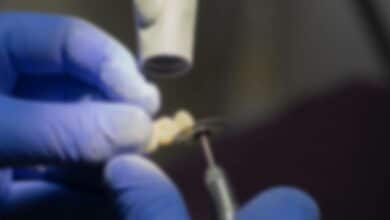 หมอถอนฟันกราม