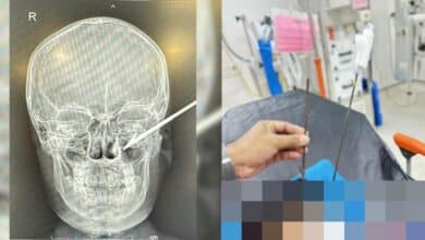 ลูกดอกปักขมับเด็ก