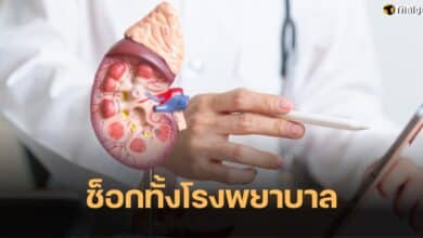นิ่วในไต 300 ก้อน