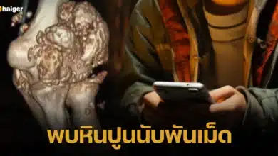 พบหินปูนนับพันเม็ด