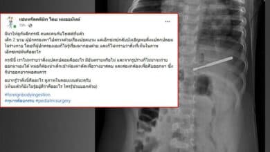 ไม้แคะหูในท้องเด็ก 2 ขวบ
