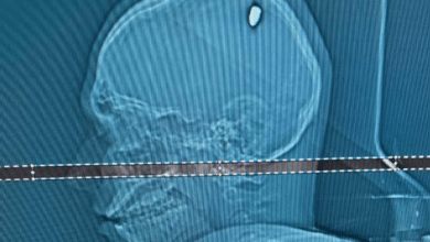 กระสุนฝังในสมอง