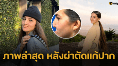 ภาพปัจจุบัน นางแบบสาวเหยื่อหมากัดปาก เปิดผลลัพธ์หลังผ่าตัดแก้ปากตลอด 3 ปี