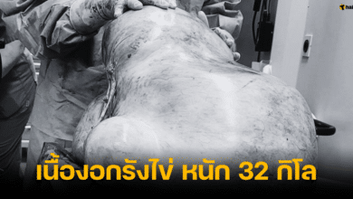 หญิงอายุ 24 ปี มีเนื้องอกรังไข่ หนัก 32 กิโลกรัม