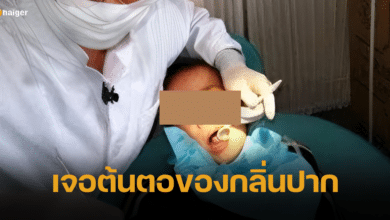 เด็กชาย 7 ขวบ ถูกเพื่อนรังเกียจ เพราะปากเหม็น แม่พาไปหาหมอ เจอต้นตอกลิ่นที่ต้องอึ้ง