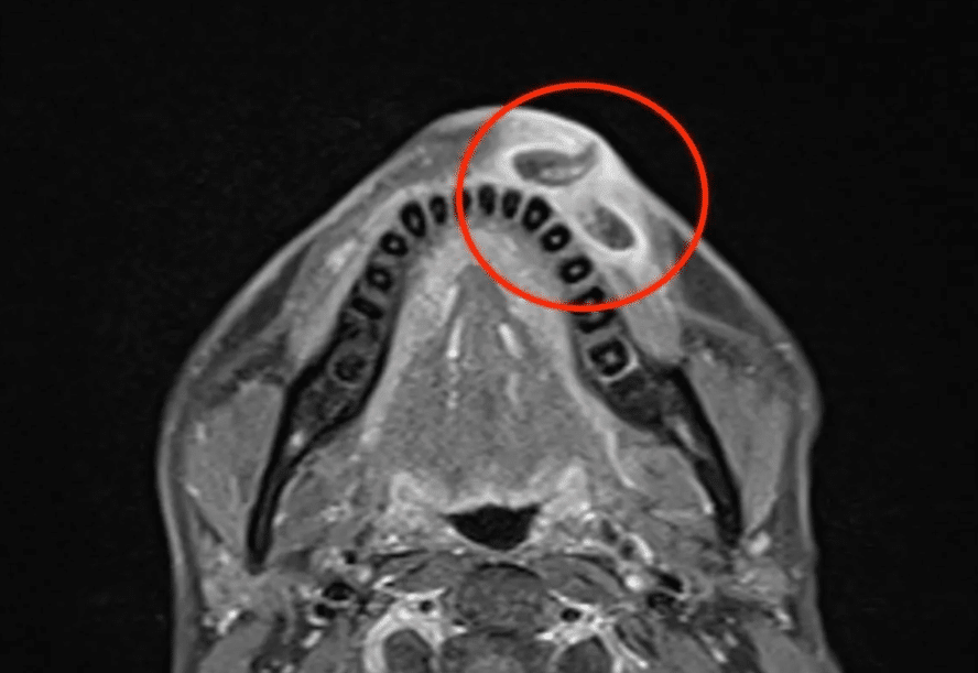 หนอนฟักตัวในปาก