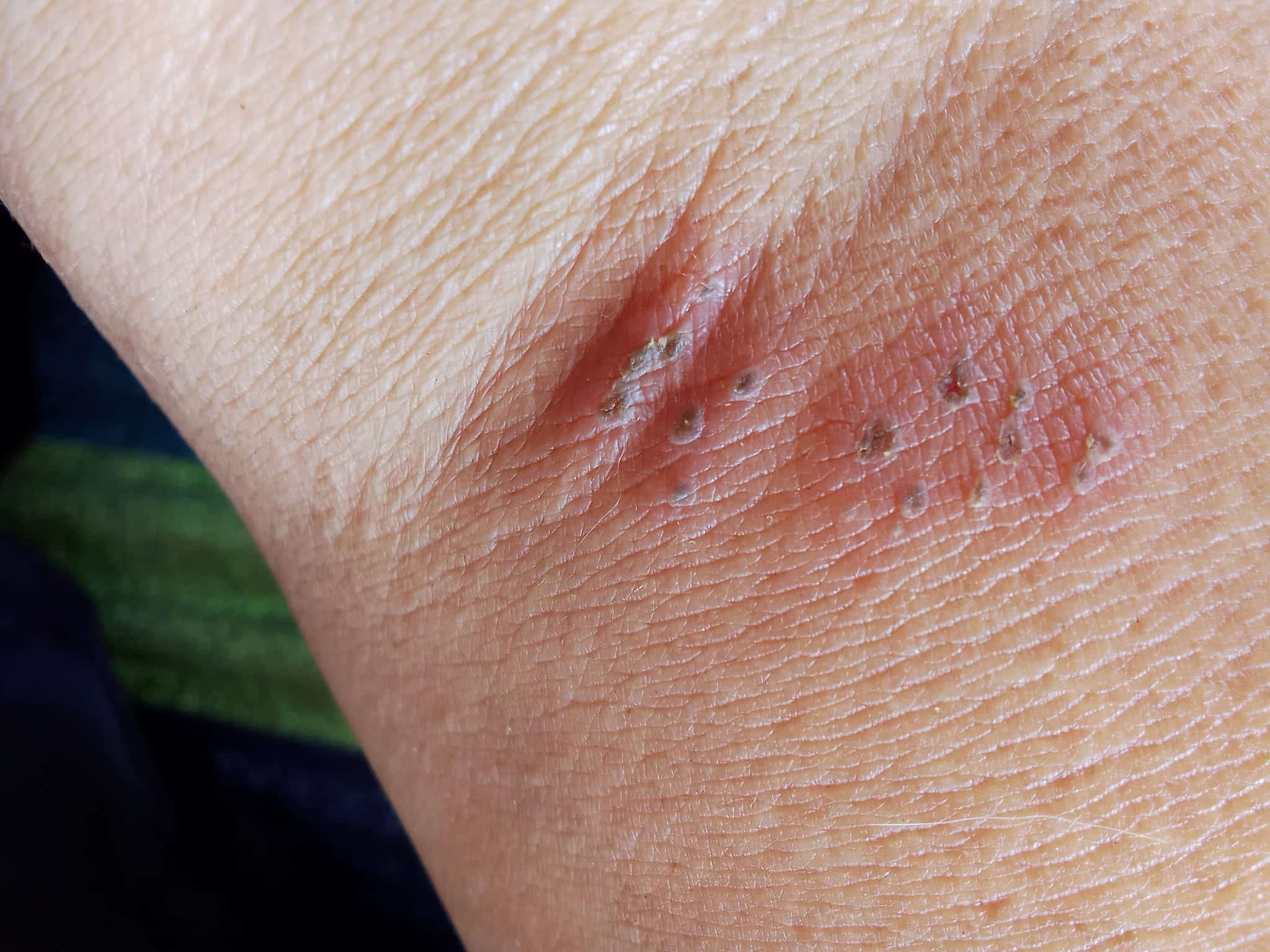 หนุ่มโพสต์ภาพ โดนตัวอะไรกัด