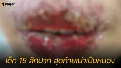 เด็ก 15 สักปาก สุดท้ายเน่าเป็นหนอง