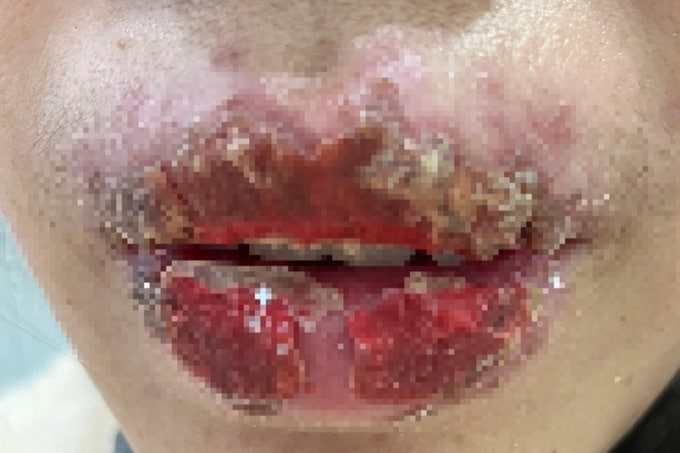 เด็ก 15 สักปาก สุดท้ายเน่าเป็นหนอง