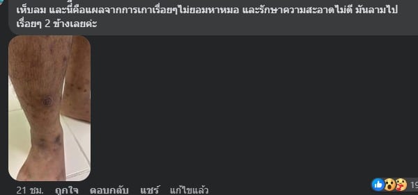 แผลเห็บลมกัด