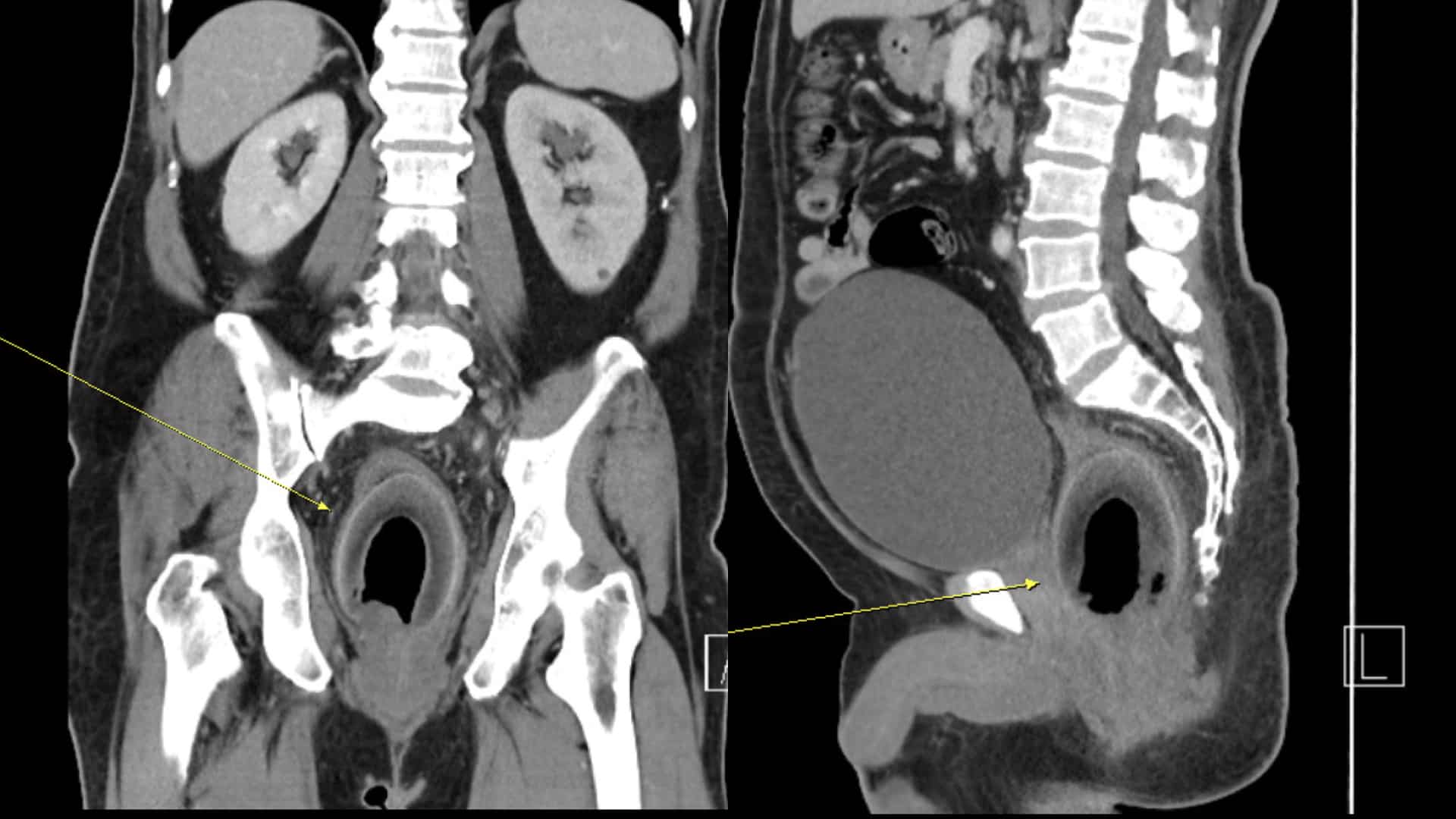 ภาพเอ็กซเรย์แสดงให้เห็นว่าลำไส้ตรงถูกขยายถึงขีดสุด