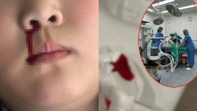 PM 2.5 เลือดกำเดาไหล