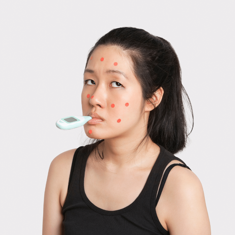 อาการของโรคหัด