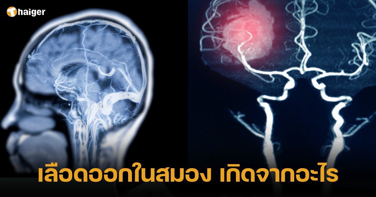 เลือดออกในสมอง เกิดจากอะไร อาการ หมดสติ