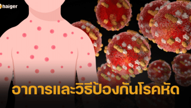 โรคหัด ภัยร้ายที่อาจคร่าชีวิต หลังเริ่มกลับมาแพร่ระบาดอีกครั้ง เช็กอาการและวิธีป้องกัน