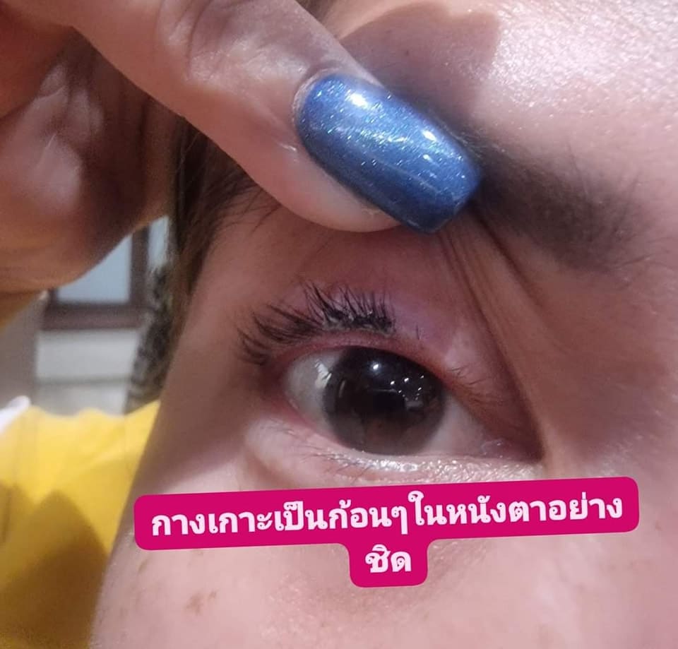 ปัญหาต่อขนตาแล้วน้ำยาถอดกาวเข้าตา