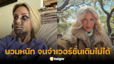 นางแบบสาว เล่าประสบการณ์จำไม่ลืม ทำรากฟันเทียม 14 ซี่ รอยช้ำเต็ม หวิดเสียโฉม