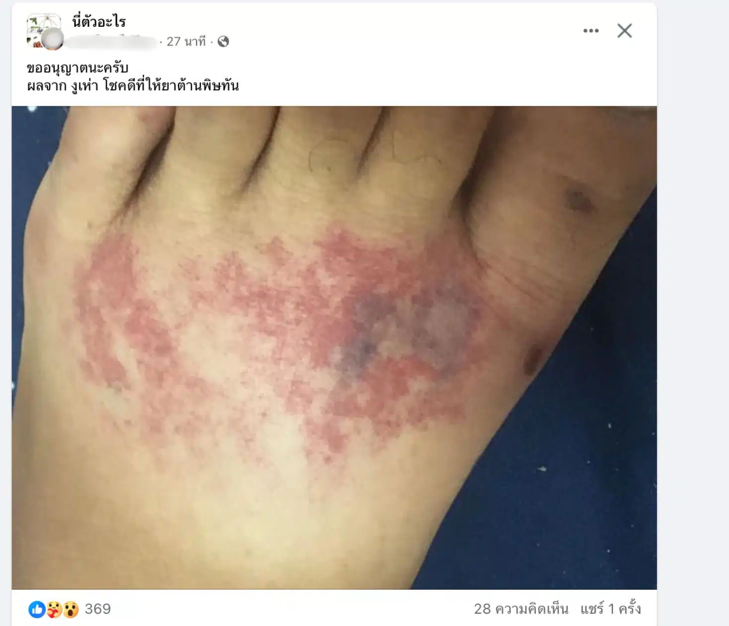 ผลจากงุเห่ากัด