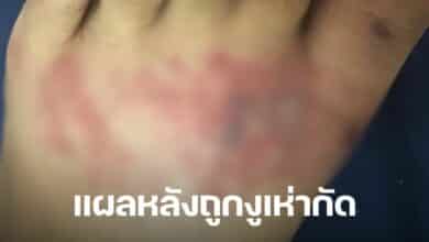 หนุ่มโชว์แผลหลังถูกงูเห่ากัด