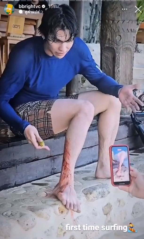 ไบร์ท-วชิรวิชญ์ ใช้มะนาวห้ามเลือดหลังเล่นเซิร์ฟ