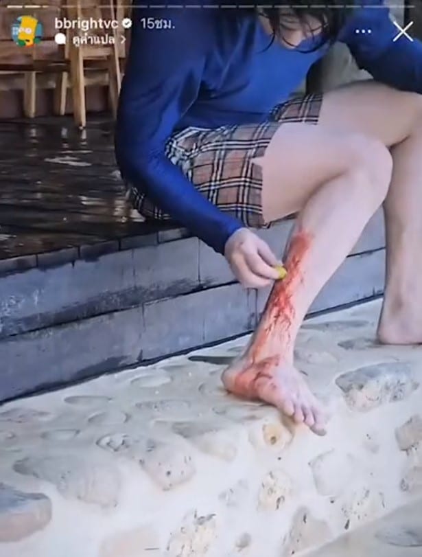 ไบร์ท-วชิรวิชญ์ บาดเจ็บหลังเล่นเซิร์ฟ