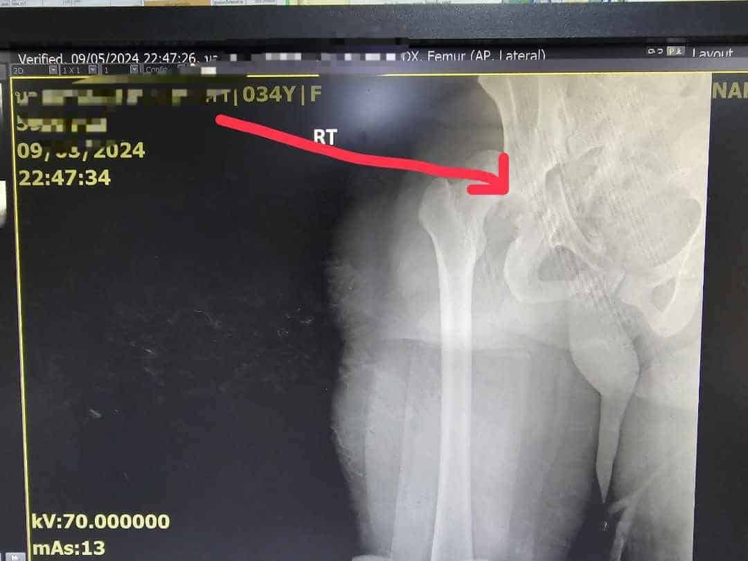 ภาพเอ็กซเรย์ พยาบาลรีเฟอร์ ประสบอุบัติเหตุ