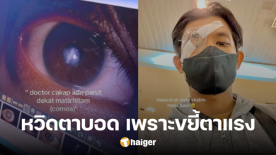 Young Man Undergoes Cornea Transplant Due to Rubbing His Eyes Excessively