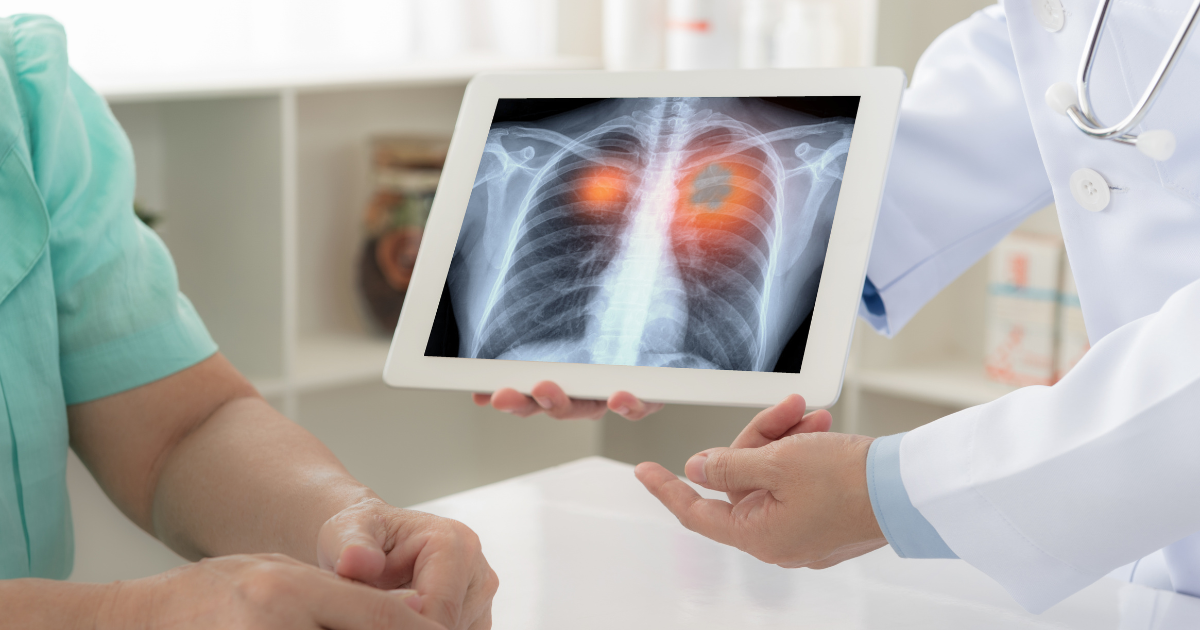 มะเร็งปอด