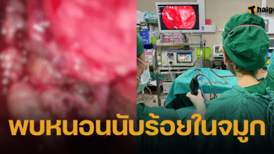 แพทย์ รพ.ดัง ส่องกล้องพบ หนอนแมลงวัน นับร้อยตัวในโพรงจมูกคนไข้วัย 59 ปี