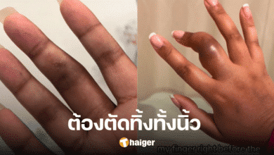 Woman's swollen finger turned out to be much worse - and then she lost it
