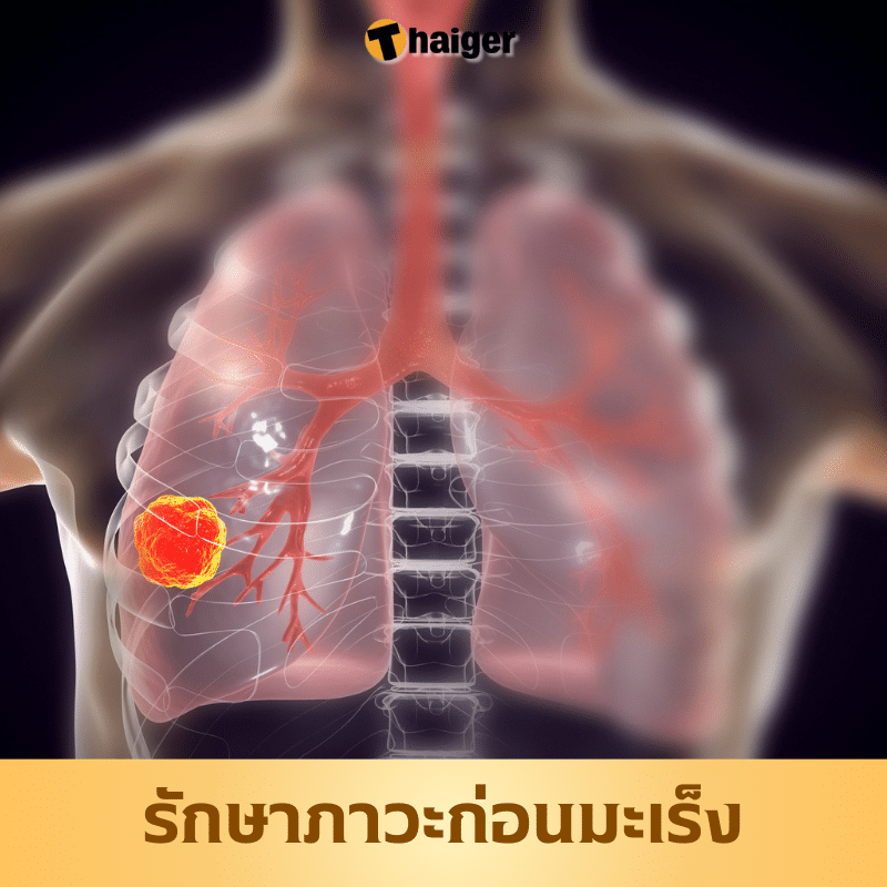 คนมีภูมิคุ้มกันมะเร็ง รักษาภาวะก่อนมะเร็ง