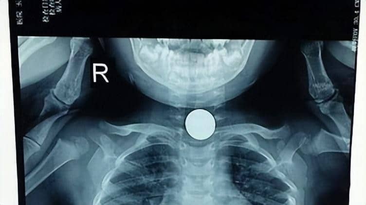 ลูกสาว 3 ขวบลูกอมติดคอ ชาวจีน