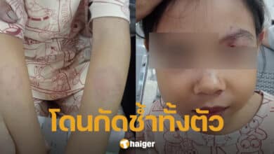 เด็กถูกเพื่อนกัดทั้งตัว-2