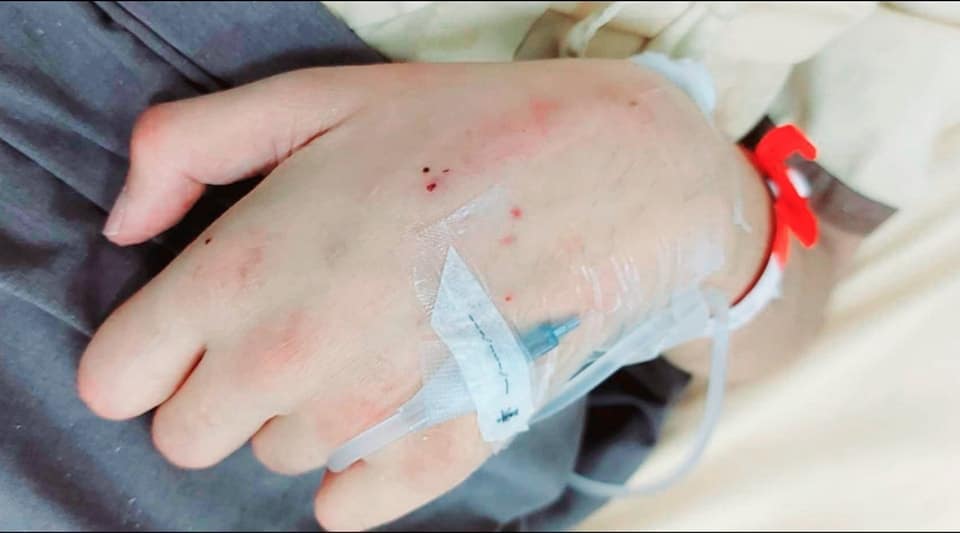 บาดแผลของอั๋นหลังจากถูกงุจงอางกัดจนกลายเป็นเจ้าชายนิทรา