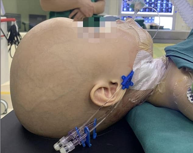 เด็กหญิงอายุหนึ่งขวบเข้ารับการผ่าตัดและเอากะโหลกศีรษะออกบางส่วนเพื่อให้แพทย์สามารถผ่าเนื้อเยื่อได้