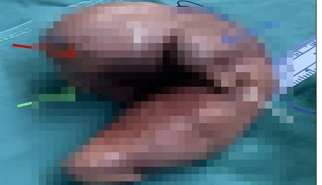 เนื้อเยื่อที่ถูกนําออกจากกะโหลกศีรษะมีความยาวประมาณ 7 นิ้ว (18 ซม.) แต่เมื่อถูกบีบอัดในกะโหลกศีรษะจะมีเส้นผ่านศูนย์กลางประมาณ 5 นิ้ว (13 ซม.)