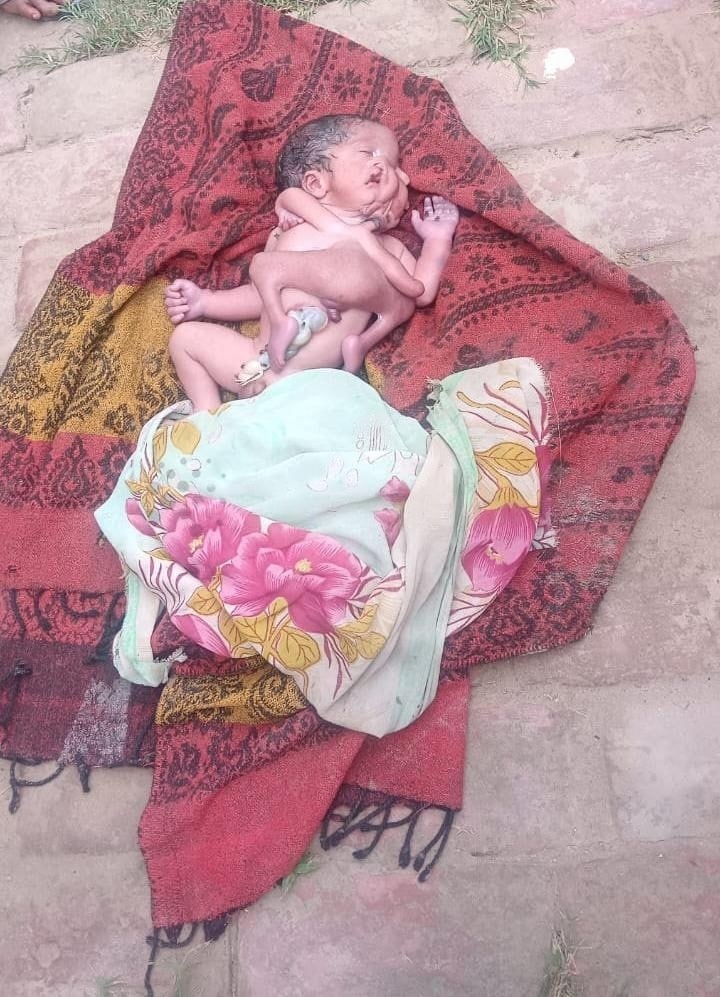 ทารกคลอดมามี 2 หน้า 8 ขา