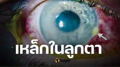 โดนผึ้งต่อยลูกตา