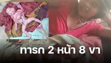 คลอดทารก 2 หน้า 8 ขา