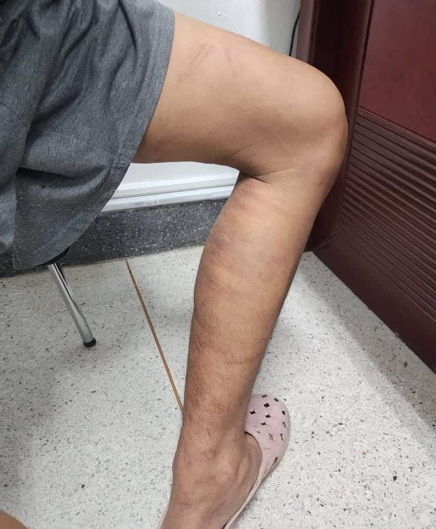 สภาพ ลูกจ้าง หลังถูกนายจ้างโหดเฆี่ยนตีทุกวัน