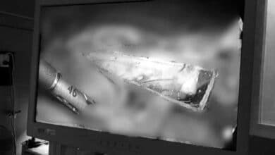 เศษแก้วปักตับ ชายรัสเซียนาน 9 ปี