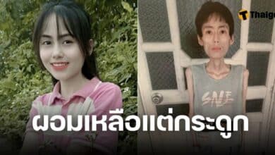 หังหุ้มติดกระดูก