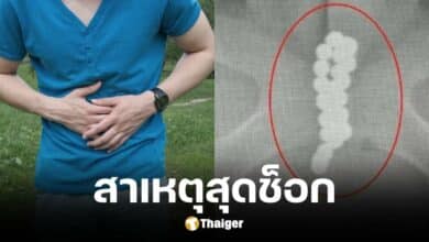 เด็ก 13 ปี กลืนแม่เหล็กลงท้องทำให้ปัสสาวะเป็นเลือด